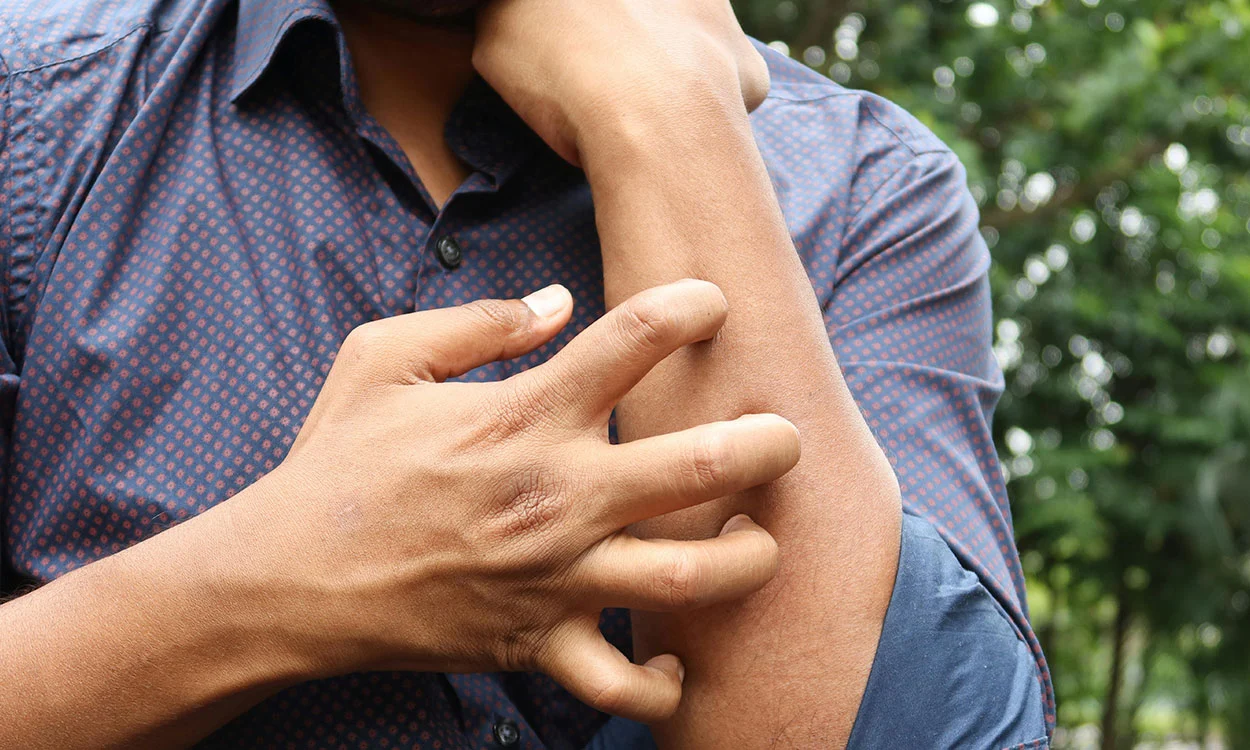 ¿Cómo aliviar el picor que causa la dermatitis?